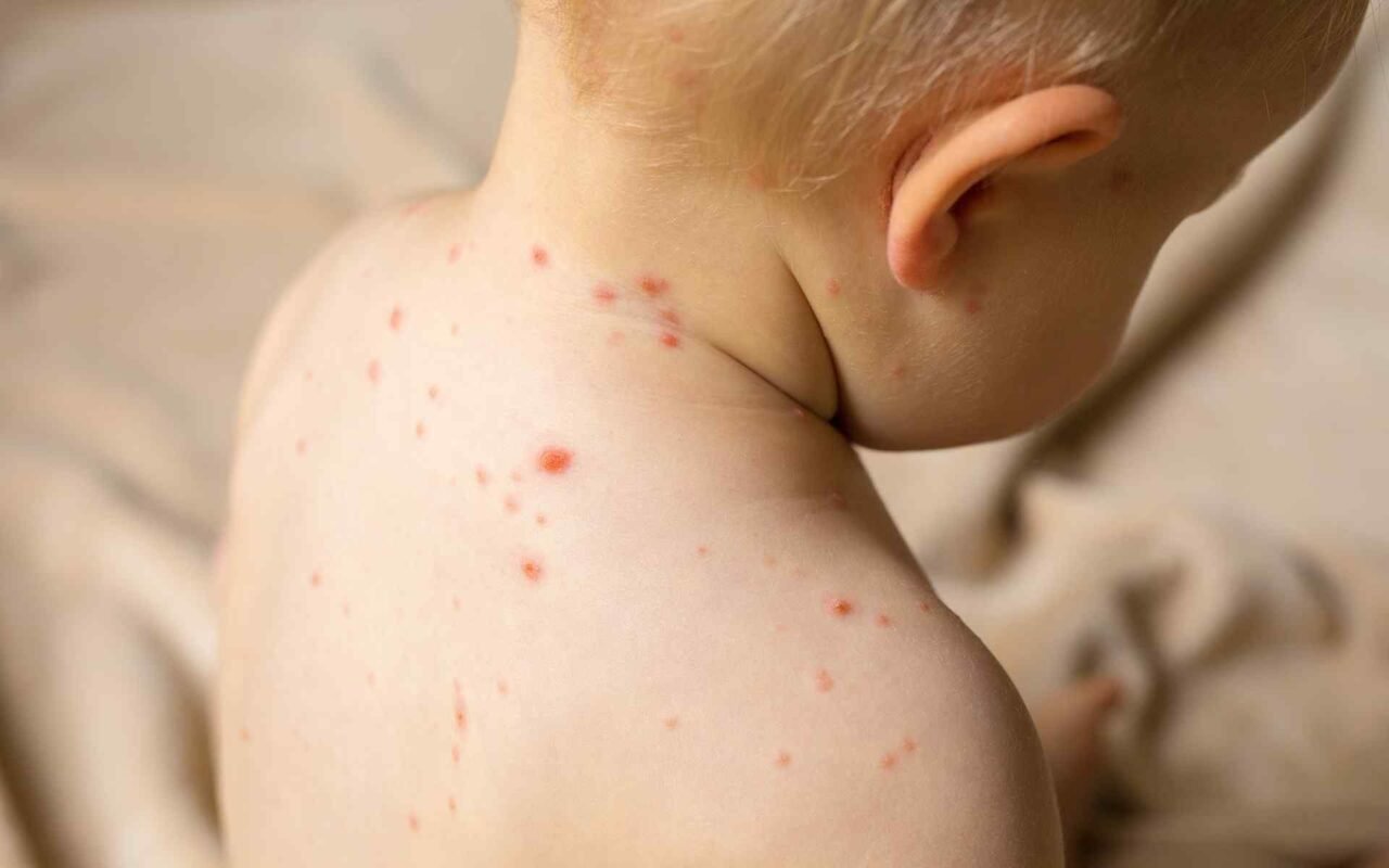 Advice: Atopic Dermatitis in Children